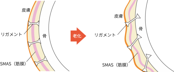 リガメントリフト